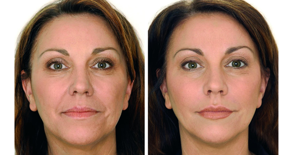Before and After: Dermal Fillers